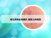 癣几种和名称图片 癣有几种类型