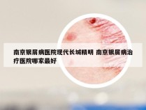 南京银屑病医院现代长城精明 南京银屑病治疗医院哪家最好