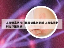 上海哪家医院打银屑病生物制剂 上海生物制剂治疗银屑病