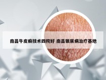 南昌牛皮癣技术四院好 南昌银屑病治疗基地