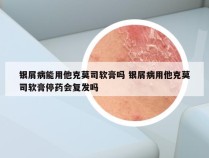 银屑病能用他克莫司软膏吗 银屑病用他克莫司软膏停药会复发吗