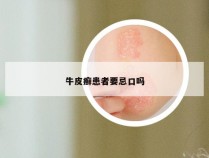 牛皮癣患者要忌口吗