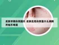 皮肤早期白斑图片 皮肤出现白斑是什么病刚开始不明显