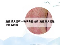 洗完澡大腿有一块块白色的皮 洗完澡大腿起皮怎么回事