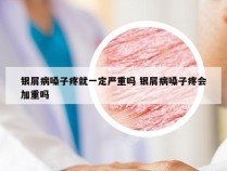 银屑病嗓子疼就一定严重吗 银屑病嗓子疼会加重吗