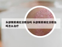 头部银屑病无法根治吗 头部银屑病无法根治吗怎么治疗