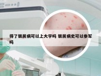 得了银屑病可以上大学吗 银屑病史可以参军吗