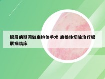 银屑病期间做扁桃体手术 扁桃体切除治疗银屑病临床