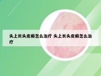 头上长头皮癣怎么治疗 头上长头皮癣怎么治疗