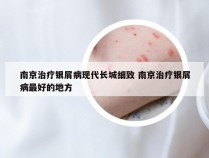 南京治疗银屑病现代长城细致 南京治疗银屑病最好的地方