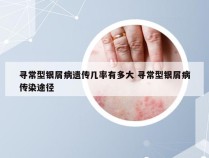 寻常型银屑病遗传几率有多大 寻常型银屑病传染途径