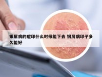 银屑病的痘印什么时候能下去 银屑病印子多久能好