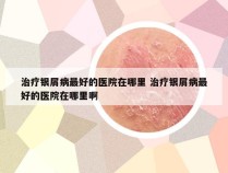 治疗银屑病最好的医院在哪里 治疗银屑病最好的医院在哪里啊