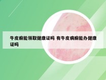 牛皮癣能领取健康证吗 有牛皮病癣能办健康证吗