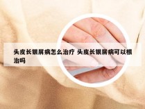 头皮长银屑病怎么治疗 头皮长银屑病可以根治吗