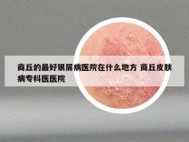 商丘的最好银屑病医院在什么地方 商丘皮肤病专科医医院