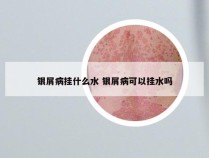 银屑病挂什么水 银屑病可以挂水吗