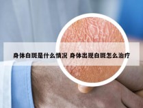 身体白斑是什么情况 身体出现白斑怎么治疗