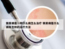 银屑病是一种什么病怎么治疗 银屑病是什么病有怎样的治疗方法