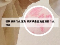 银屑病田什么洗澡 银屑病患者洗完澡用什么保湿