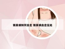 银屑病如何自愈 银屑病自愈征兆