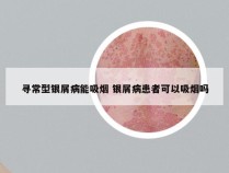 寻常型银屑病能吸烟 银屑病患者可以吸烟吗