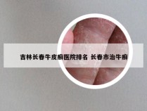 吉林长春牛皮癣医院排名 长春市治牛癣