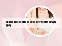 肩周炎会影响银屑病 肩周炎会影响银屑病复发吗