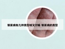 银屑病有几种类型哦又付嘛 银屑病的类型