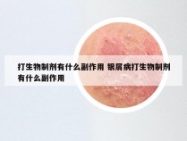 打生物制剂有什么副作用 银屑病打生物制剂有什么副作用