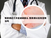 银屑病近几年能被破解么 银屑病以后有望根治吗