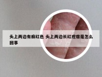 头上两边有癣红色 头上两边长红疙瘩是怎么回事