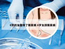 6岁的女童得了银屑病 6岁女孩银屑病