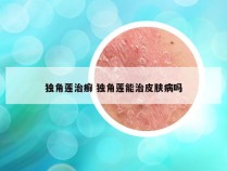 独角莲治癣 独角莲能治皮肤病吗