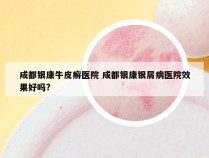 成都银康牛皮癣医院 成都银康银屑病医院效果好吗?