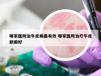 哪家医院治牛皮癣最有效 哪家医院治疗牛皮肤癣好