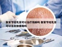 联苯苄唑乳膏可以治疗钱癣吗 联苯苄唑乳膏可以治皮肤瘙痒吗