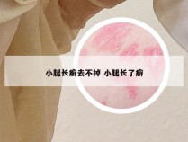 小腿长癣去不掉 小腿长了癣