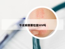 牛皮癣需要检查HIV吗