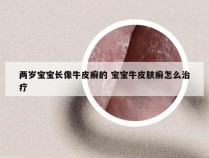 两岁宝宝长像牛皮癣的 宝宝牛皮肤癣怎么治疗