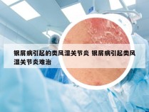 银屑病引起的类风湿关节炎 银屑病引起类风湿关节炎难治