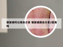 银屑病可以用白介素 银屑病用白介素2管用吗