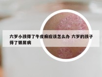 六岁小孩得了牛皮癣应该怎么办 六岁的孩子得了银屑病