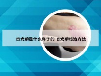 日光癣是什么样子的 日光癣根治方法