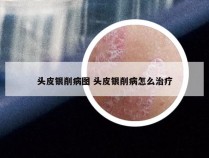 头皮银削病图 头皮银削病怎么治疗