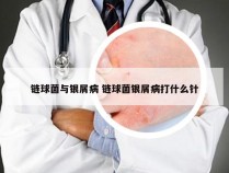 链球菌与银屑病 链球菌银屑病打什么针