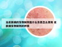 治皮肤病的生物制剂是什么东西怎么使用 皮肤病生物制剂的种类