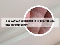 北京治疗牛皮癣那家医院好 北京治疗牛皮肤癣最好的医院是哪个