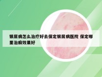 银屑病怎么治疗好去保定银屑病医院 保定哪里治癣效果好