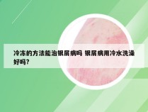 冷冻的方法能治银屑病吗 银屑病用冷水洗澡好吗?